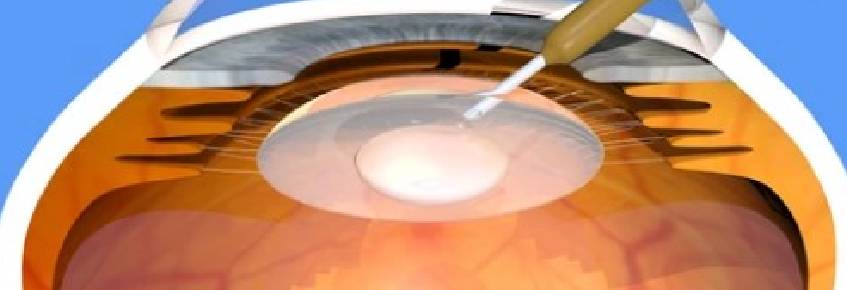 Phaco Emulsification