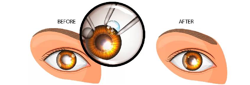 Cataract Surgery